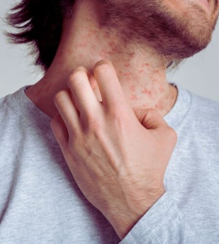 Natural Ways to Soothe Eczema